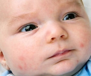 mam non hoa mi phuong phap tri mun trung ca cho tre moi sinh